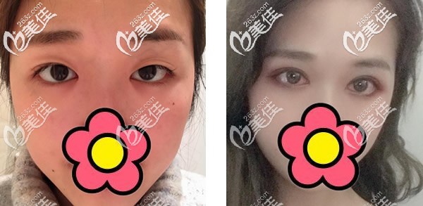眼綜合3個月恢復(fù)效果圖