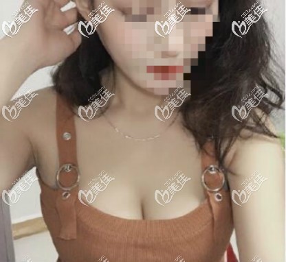 做完曼托水滴225cc假體隆胸后從B晉升到C,胸一點不小平躺也自然