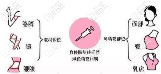 自體脂肪移植填充 自體脂肪移植填充