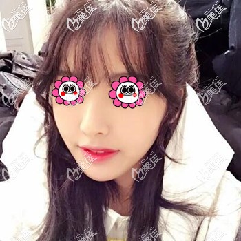 用我做面部埋線(xiàn)提升打造小v臉的親身經(jīng)歷來(lái)告訴你術(shù)后多久有效果？