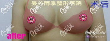 我在泰國曼古雨季做的假體隆胸親身經(jīng)歷給你參考泰國隆胸技術(shù)怎么樣