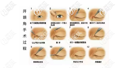 開眼角手術(shù)過程圖解