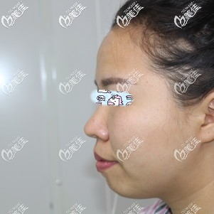 做假體墊下巴術(shù)前后縮的下頦 做假體墊下巴術(shù)前后縮的下頦