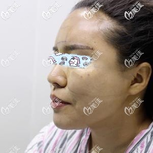 硅膠墊下巴術(shù)后12天效果 硅膠墊下巴術(shù)后12天效果