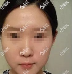 術(shù)前鼻子塌平 術(shù)前鼻子塌平