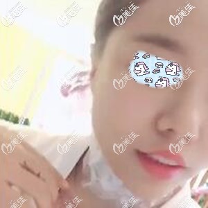 假體墊下巴術(shù)后30天婆婆嘴變輕 假體墊下巴術(shù)后30天婆婆嘴變輕