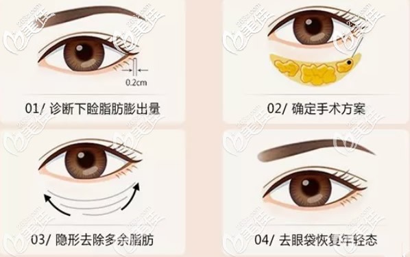 聚能美雕祛眼袋過程 聚能美雕祛眼袋過程