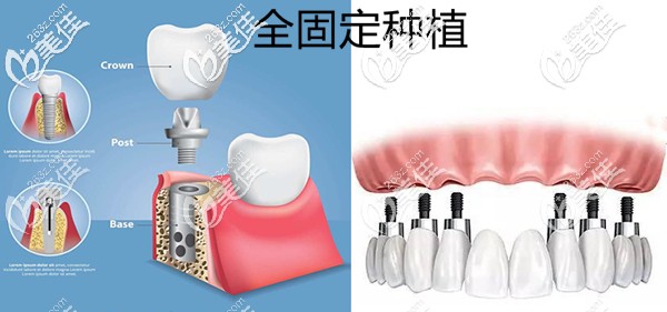 全口固定種植牙原理示意圖 全口固定種植牙原理示意圖