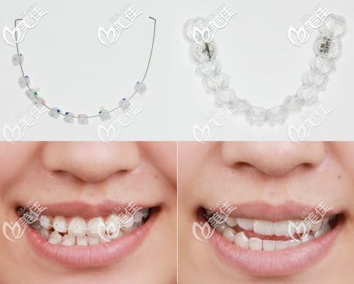 托槽矯正和隱形矯正對比