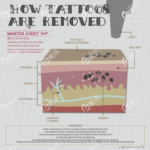 激光洗紋身的原理 激光洗紋身的原理