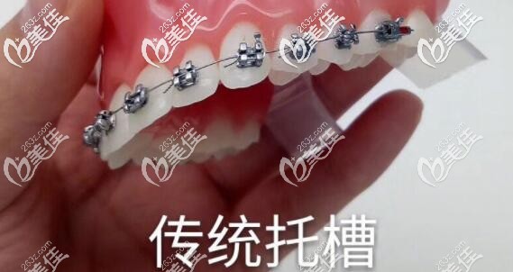 傳統(tǒng)金屬托槽矯正器