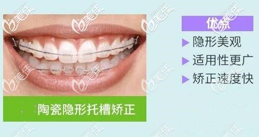 半隱形陶瓷托槽矯正器