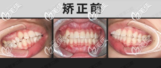 突嘴齙牙在北京牙管家口腔矯正前照片 突嘴齙牙在北京牙管家口腔矯正前照片