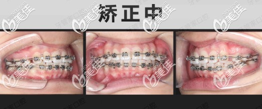 骨性齙牙做金屬自鎖托槽矯正中 骨性齙牙做金屬自鎖托槽矯正中