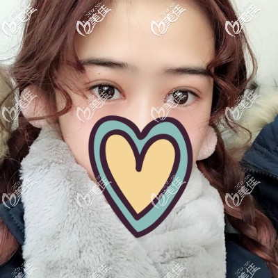 眼綜合手術(shù)48天恢復(fù)圖 眼綜合手術(shù)48天恢復(fù)圖