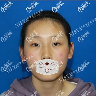 做雙眼皮開內(nèi)眼角術(shù)前照 做雙眼皮開內(nèi)眼角術(shù)前照