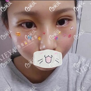 在長沙割雙眼皮開眼角術(shù)后3天效果圖 在長沙割雙眼皮開眼角術(shù)后3天效果圖