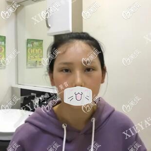 割雙眼皮開眼角7天拆線 割雙眼皮開眼角7天拆線