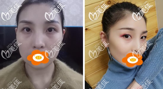 做埋線提升一個(gè)月對(duì)比圖 做埋線提升一個(gè)月對(duì)比圖