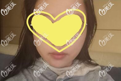 千萬別做面部吸脂嘴角邊,嘴角兩坨肉下垂吸脂沒效果反而有鼓包