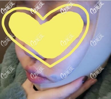 臉部抽脂術(shù)后需要堅(jiān)持戴頭套一個(gè)月