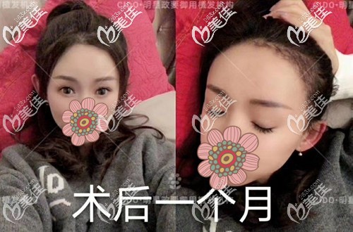 前額發(fā)際線種植一個(gè)月效果圖