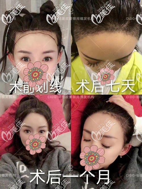 發(fā)際線種植手術(shù)恢復(fù)過(guò)程