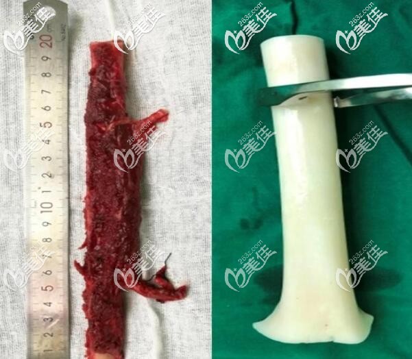 異體骨隆鼻材料 異體骨隆鼻材料