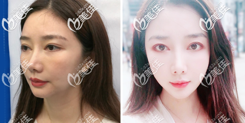 深圳非凡第五代熱瑪吉全臉案例對(duì)比圖片 深圳非凡第五代熱瑪吉全臉案例對(duì)比圖片