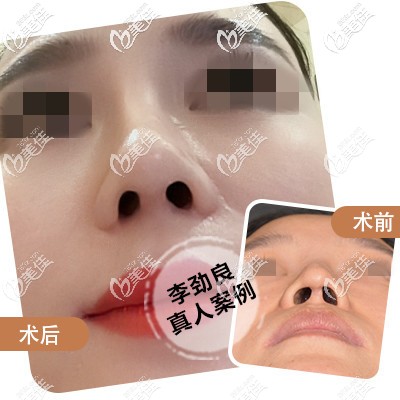 李勁良院長鼻小柱整形案例