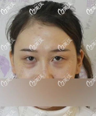 赤峰紫潔葉子整形劉文峰院長不開刀去眼袋前 赤峰紫潔葉子整形劉文峰院長不開刀去眼袋前