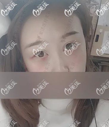 赤峰紫潔去眼袋第二天 赤峰紫潔去眼袋第二天