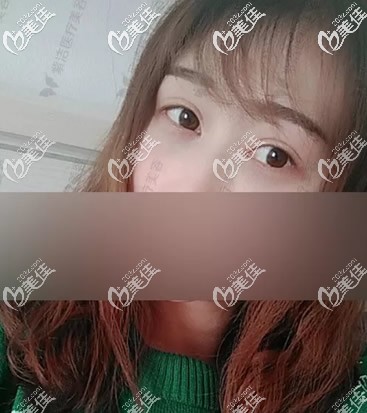 無痕去眼袋+自體脂肪填充淚溝第十天效果 無痕去眼袋+自體脂肪填充淚溝第十天效果