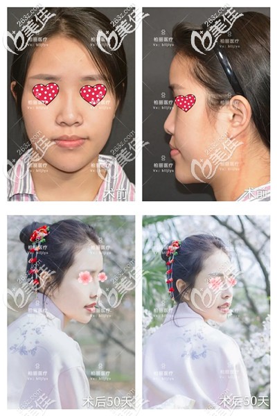 找李勁良醫(yī)生隆鼻前后對比