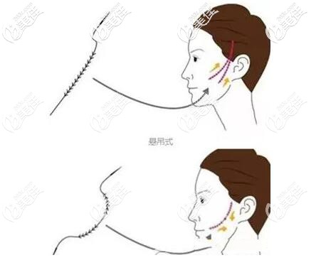 埋線(xiàn)提升的埋入位置