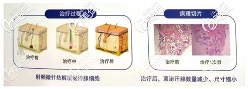 黃金微針治療狐臭的原理和效果 黃金微針治療狐臭的原理和效果