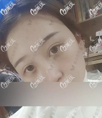 赤峰紫潔劉文峰不開刀去眼袋第3天 赤峰紫潔劉文峰不開刀去眼袋第3天