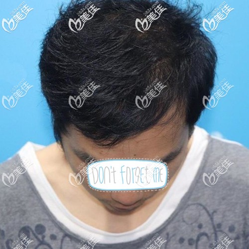 還在質(zhì)疑廣州倍生植發(fā)靠不靠譜?那就來看看我頭發(fā)加密種植4000毛囊單位后的效果吧