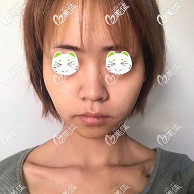 做顴骨內(nèi)推前我的樣子 做顴骨內(nèi)推前我的樣子