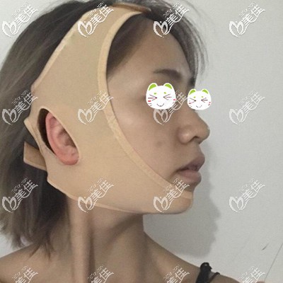 做顴骨整形半個月后還戴著頭套 做顴骨整形半個月后還戴著頭套