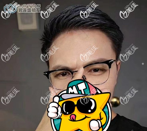 竟然這樣應(yīng)對我的m型脫發(fā)—在發(fā)際線處種植了1600毛囊單位！