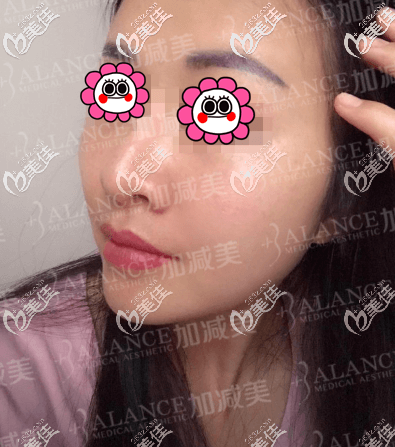 做V美減齡 V6復(fù)位青春術(shù)第7天