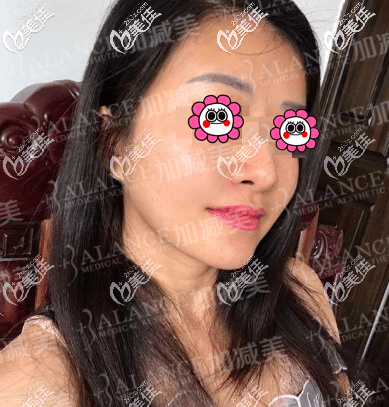 做V美減齡提升抗衰一個(gè)月樣子