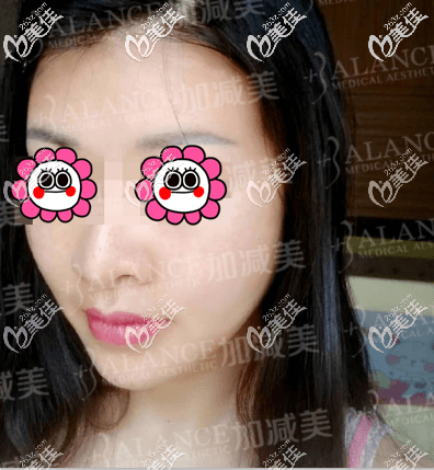 做V6復(fù)位青春術(shù)5個(gè)月了