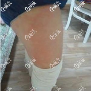大腿吸脂術(shù)前肥碩的腿部 大腿吸脂術(shù)前肥碩的腿部