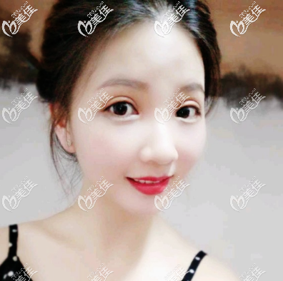 深圳瑞芙臣劉顏顏醫(yī)生雙眼皮術(shù)后4天效果 深圳瑞芙臣劉顏顏醫(yī)生雙眼皮術(shù)后4天效果