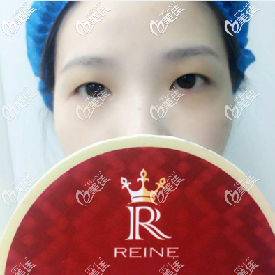 去深圳瑞芙臣做雙眼皮前的樣子 去深圳瑞芙臣做雙眼皮前的樣子