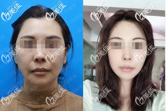 加減美v6提升一個月效果圖