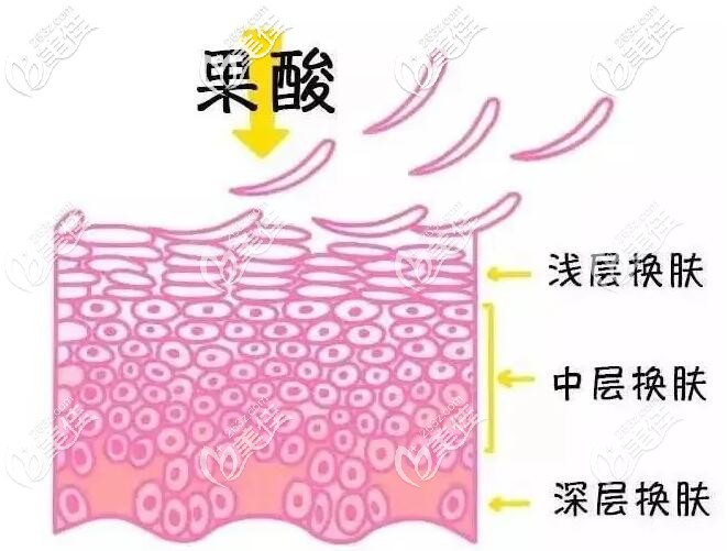 果酸治療雞皮膚的原理 果酸治療雞皮膚的原理