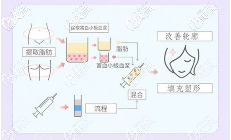 脂肪填充原理圖 脂肪填充原理圖